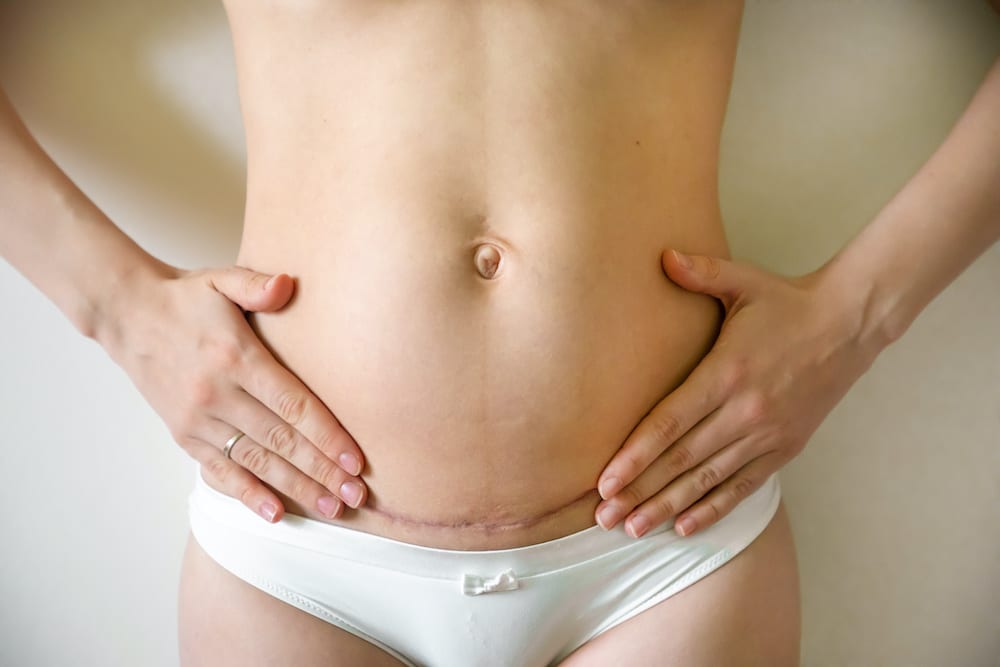 Beauty Med  How to Get Rid of Stomach Pooch & Lower Belly Fat